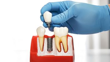 Considering Dental Implants in Tampa? Read This First