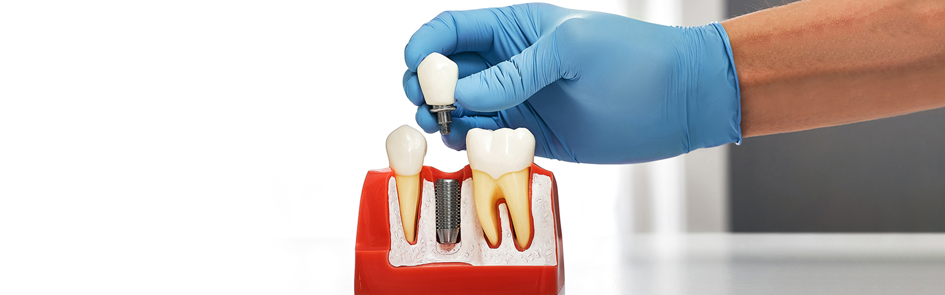 Considering Dental Implants in Tampa? Read This First
